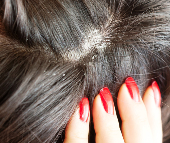 Как лечить волосы в домашних условиях от перхоти?