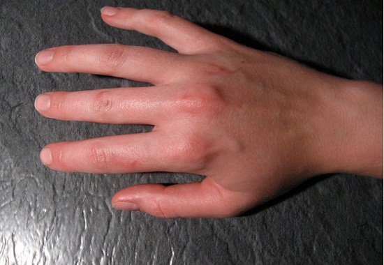 Ревматизм рук: симптомы