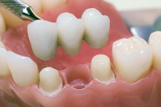 стоматологические виниры