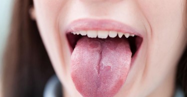 Белый налет на языке: причины появления и способы лечения, профилактики