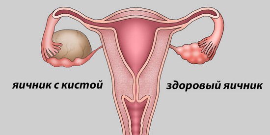 Как лечить кисту яичника, симптомы у женщин