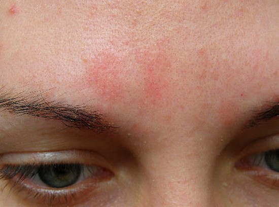 Красные шелушащиеся пятна на лице: причины, способы лечения
