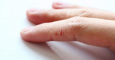 Эффективные способы лечения трещин на пальцах рук