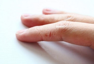 Эффективные способы лечения трещин на пальцах рук